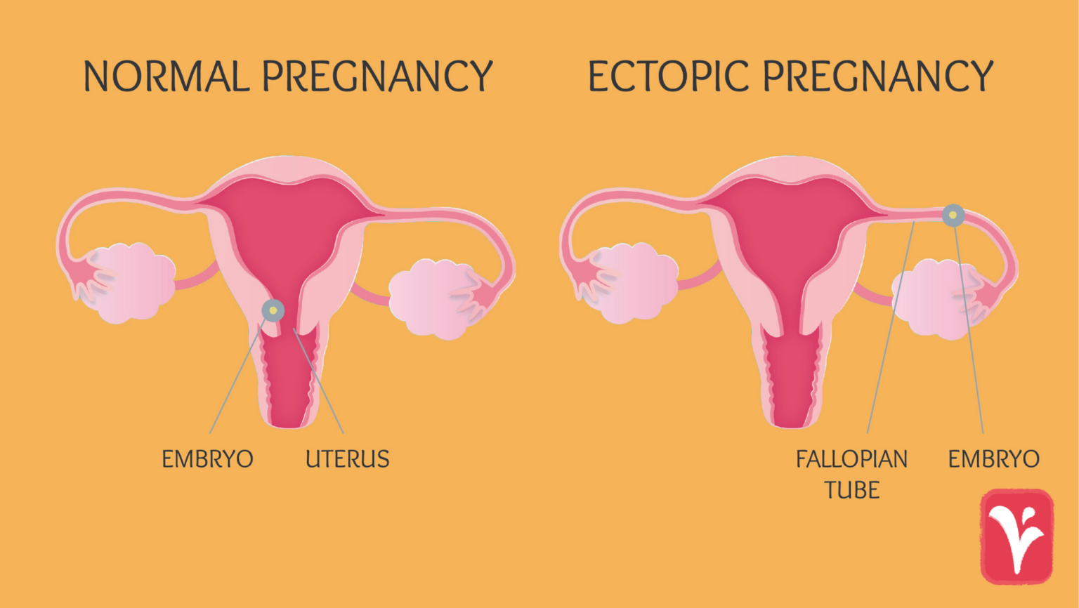 Ectopic Pregnancies What You Need To Know Austin Women s Health Center